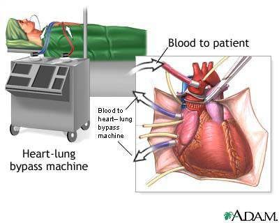 Heart-Lung Machine